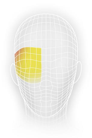 Cluster headache